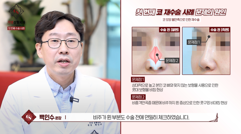 Why You Should Have Revision Rhinoplasty at a Place That Specializes in Apgujeong Nose Revision Surgery (ft. Dr. Baek In-soo) image 3