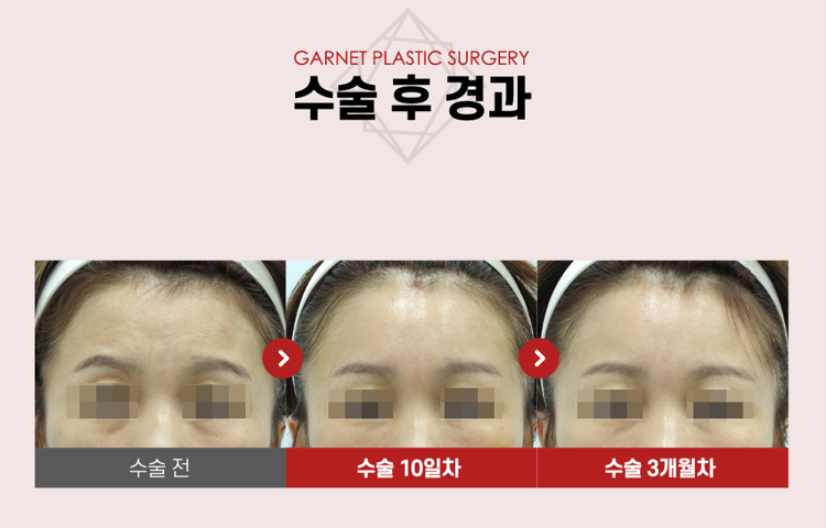 【가넷성형외과 백인수원장 성형칼럼】 펜타픽스이마거상으로 눈썹 비대칭 교정 관련 이미지 7
