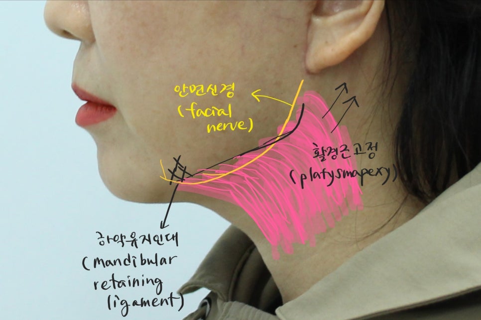 안면거상과 함께하는 목거상술 관련 이미지 4