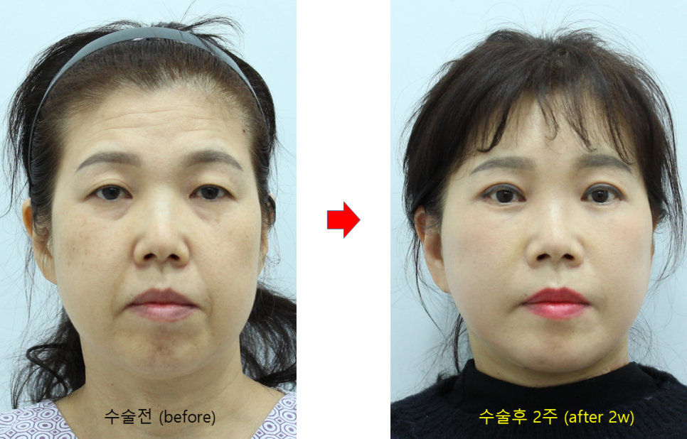 Pre- and Post-Operative Precautions for Faster Recovery After Plastic Surgery image 9