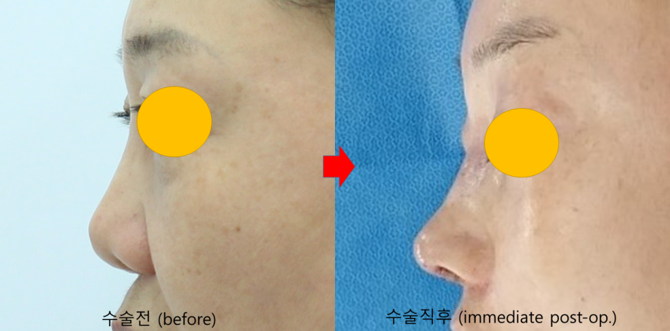 Use of Rib Cartilage in Midlife Rhinoplasty image 8