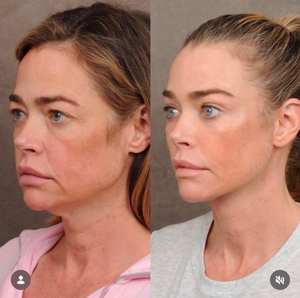 The Result of the $200,000 Anti-Aging Surgery Chosen by a Hollywood Star image 9