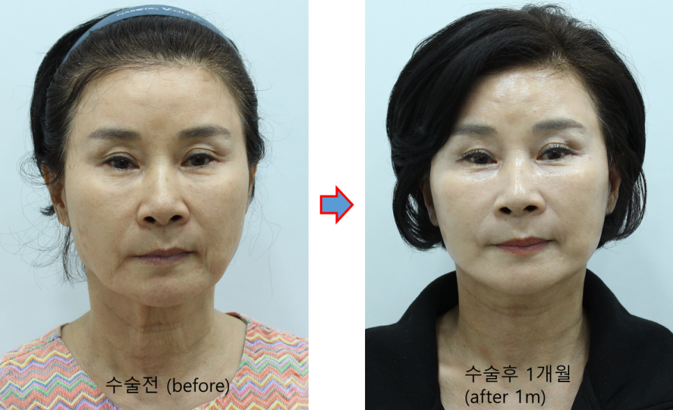 &ldquo;목이 나이를 결정한다: 안면거상과 함께 목거상을 해야 하는 이유&rdquo; 관련 이미지 3