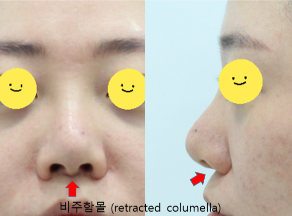늑연골을 이용한 비주함몰의 교정 관련 이미지 2
