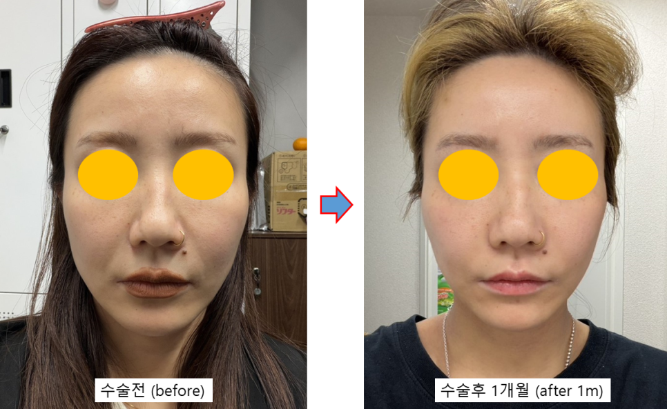 A Deep Mini Facelift Case for a Japanese Patient Who Was Disappointed with the Longevity of Thread Lifting image 4