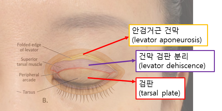 쌍꺼풀이 풀리고 눈두덩이가 꺼졌다면? 재수술로 살펴본 원인 관련 이미지 2