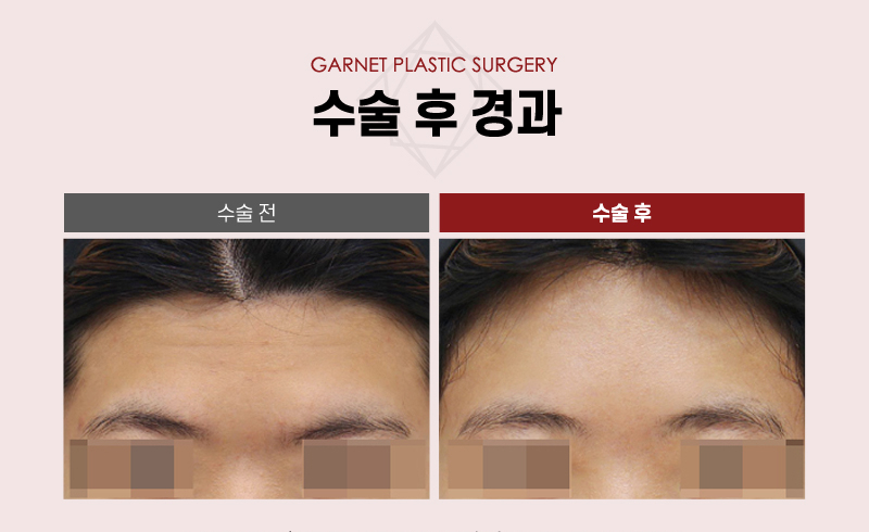 【가넷성형외과 백인수원장 성형칼럼】 20대 여성 펜타픽스 이마거상으로 이마 모양과 눈썹 교정 관련 이미지 6
