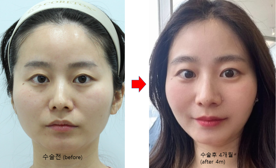눈밑지방재배치와 애교살지방이식의 유지기간 관련 이미지 6