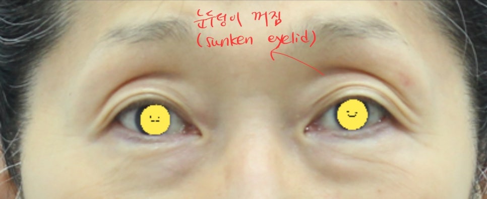 Upper Eyelid Surgery with Upper Eyelid Fat Repositioning image 1