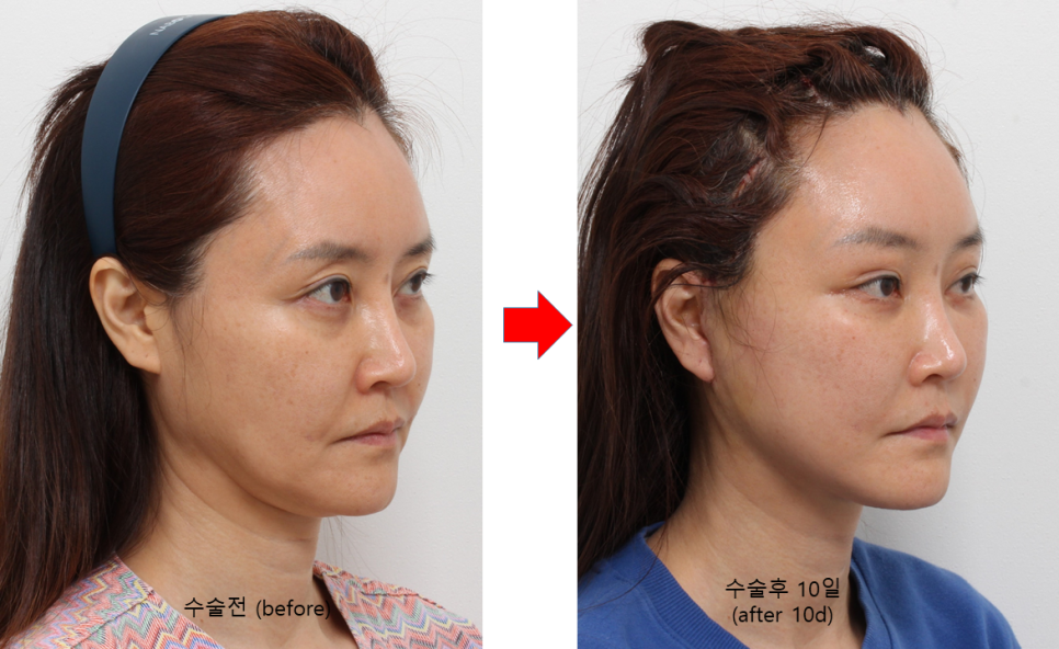 사각턱 수술 후 처진 턱라인을 개선하는 딥 미니거상 관련 이미지 4
