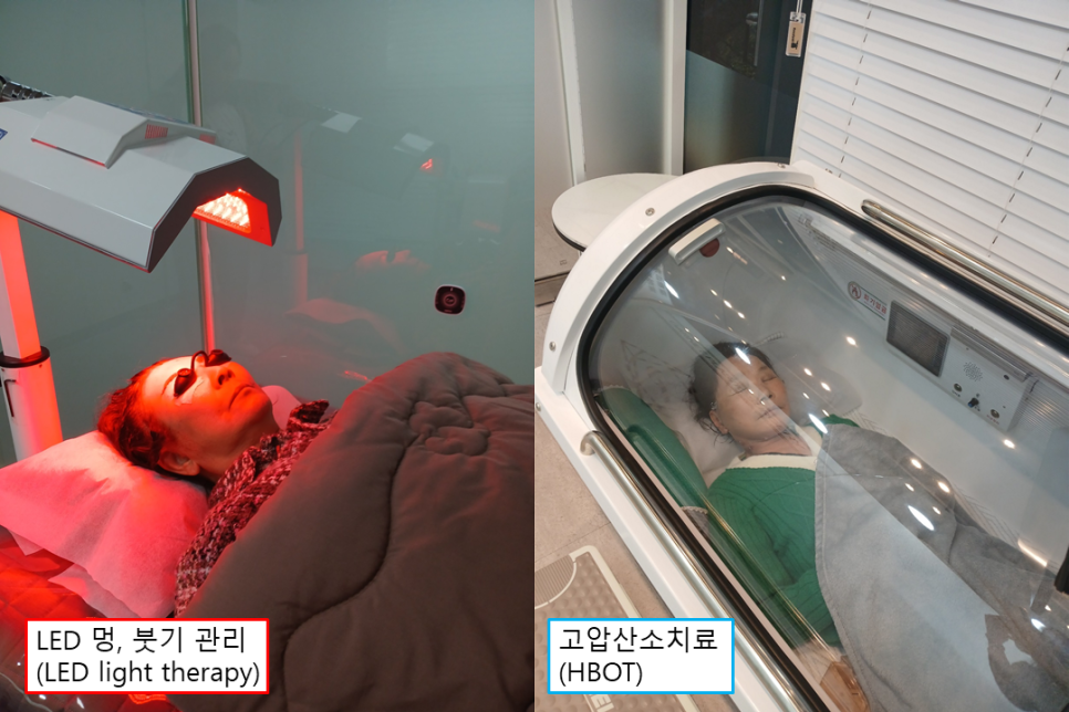 70대 안면거상 가능할까? 회복과정과 3개월 전후 실제 사례 관련 이미지 3