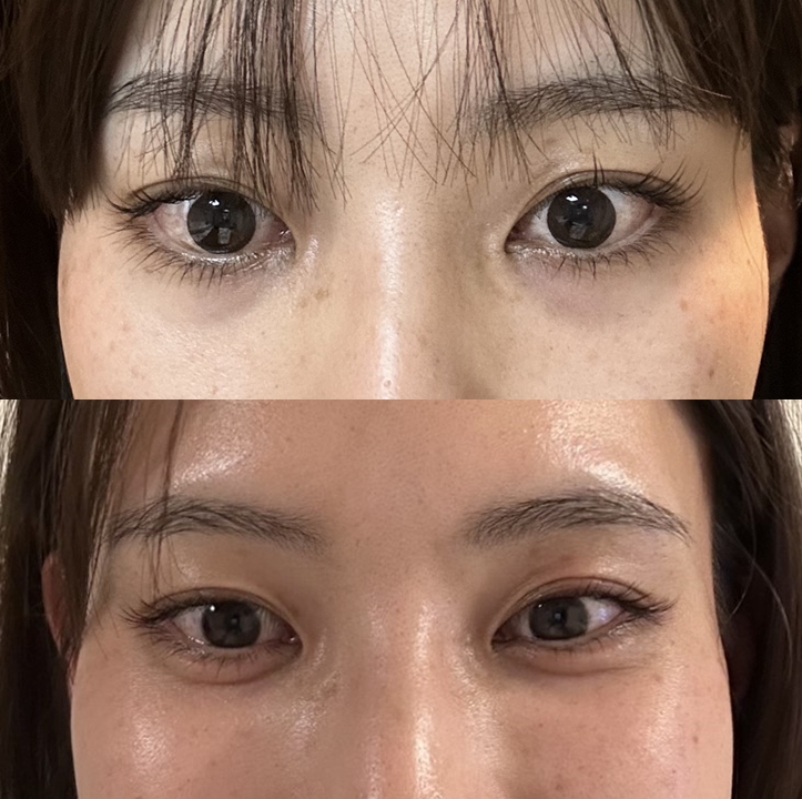 Natural-Looking Under-Eye Fat Repositioning, Even in Facial Expressions: Key Points That Determine the Results image 4