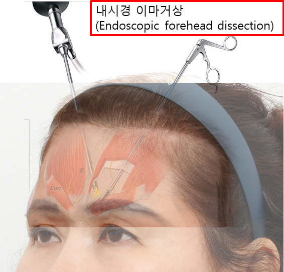 복합적인 눈 문제, 하나의 수술보다 원인별 교정이 중요한 이유 관련 이미지 5