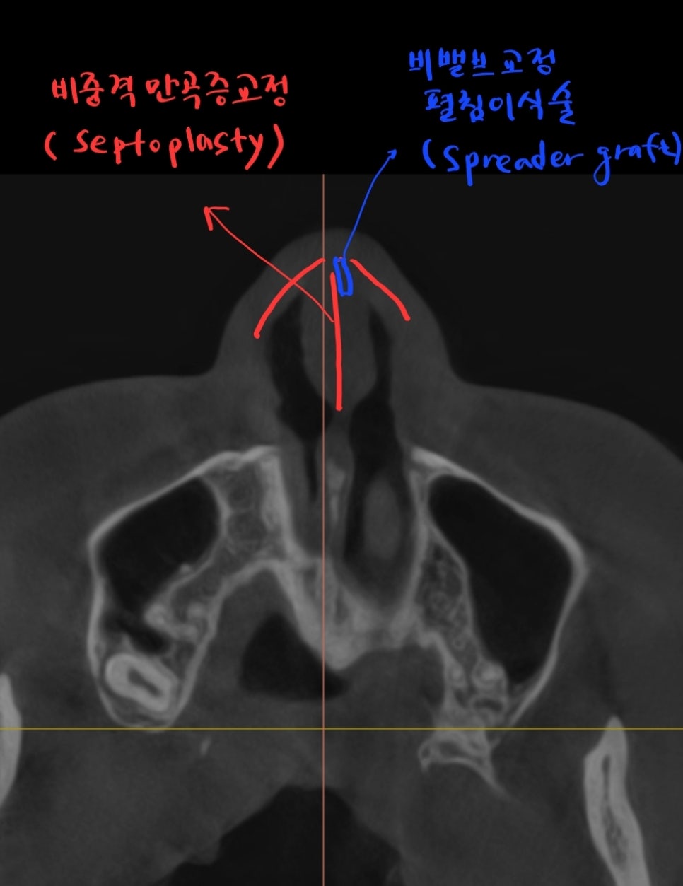 Rib Cartilage Rhinoplasty for a Deviated Saddle Nose image 9