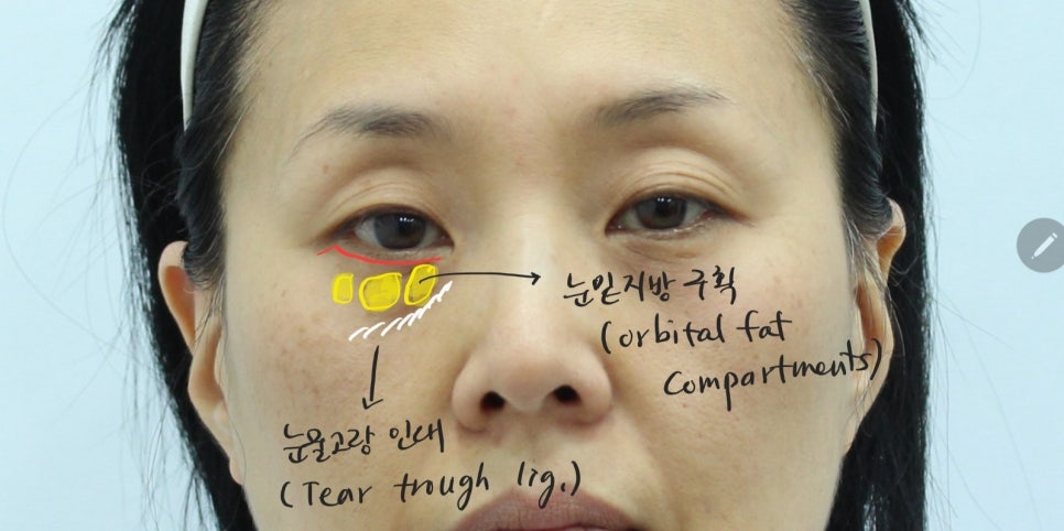 Lower Blepharoplasty in Your 50s to Add Firmness to the Midface image 2