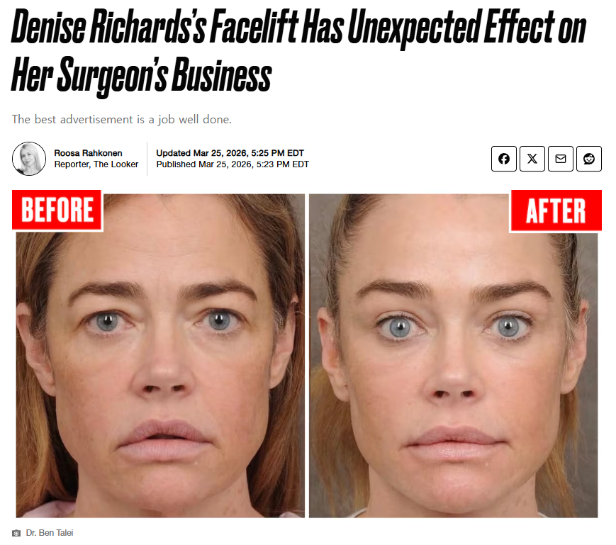 The Result of the $200,000 Anti-Aging Surgery Chosen by a Hollywood Star image 2