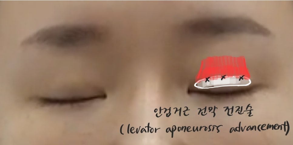 Double Eyelid Surgery and Ptosis Correction image 4