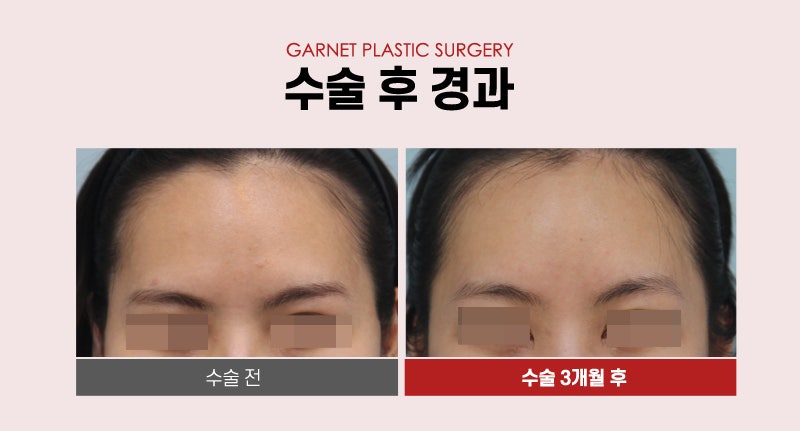 【Garnet Plastic Surgery Director Baek In-soo’s Plastic Surgery Column】 Improving Brow Ptosis with a Pentafix Forehead Lift in One’s 20s image 5