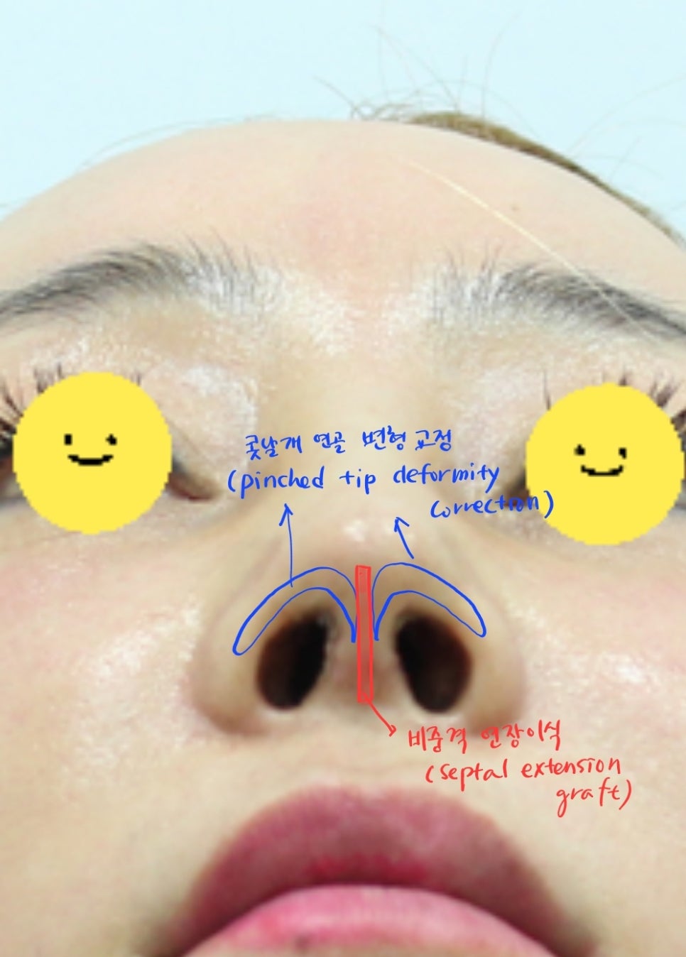 Correction of a Pinched Nose or Indented Nose image 7