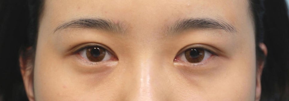 Lateral and Lower Canthoplasty with Under-Eye Fat Repositioning image 1