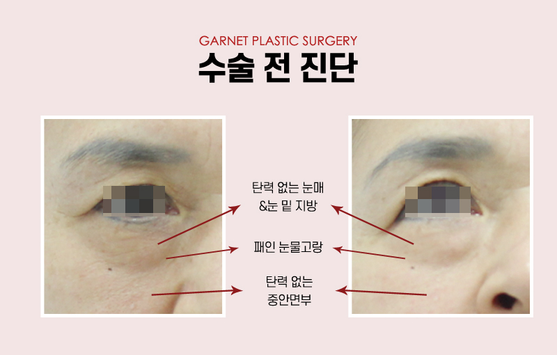 【가넷성형외과 백인수원장 성형칼럼】 60대 쿼드플러스 하안검 수술 관련 이미지 3