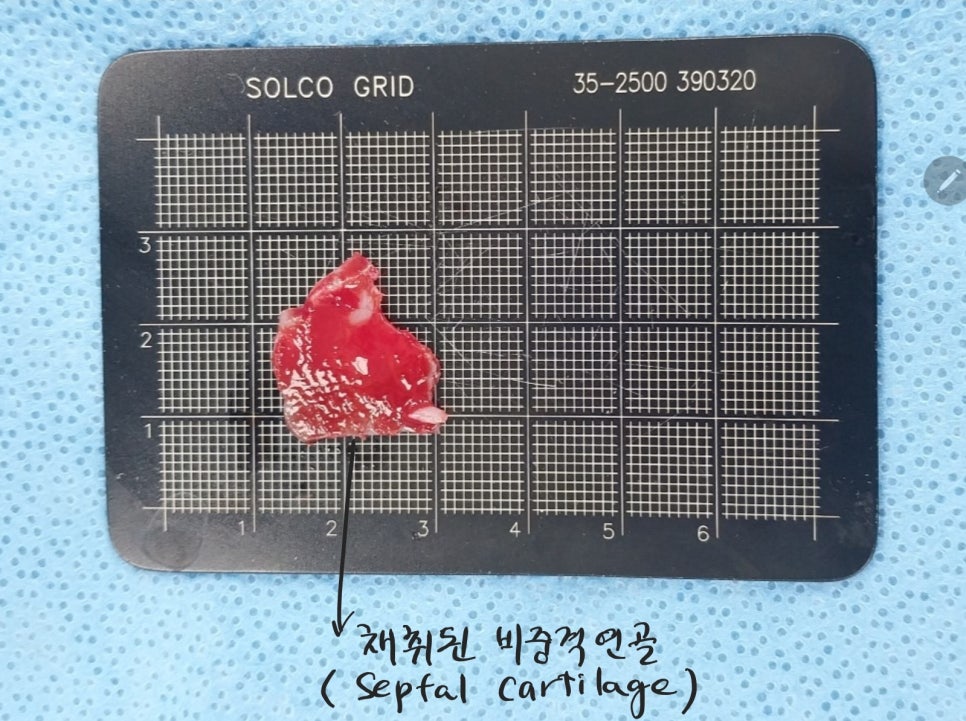 트렌드 변화에 따른 중년코 재수술 관련 이미지 3