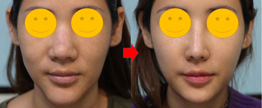 Causes of Nasolabial Folds and How to Address Them image 4