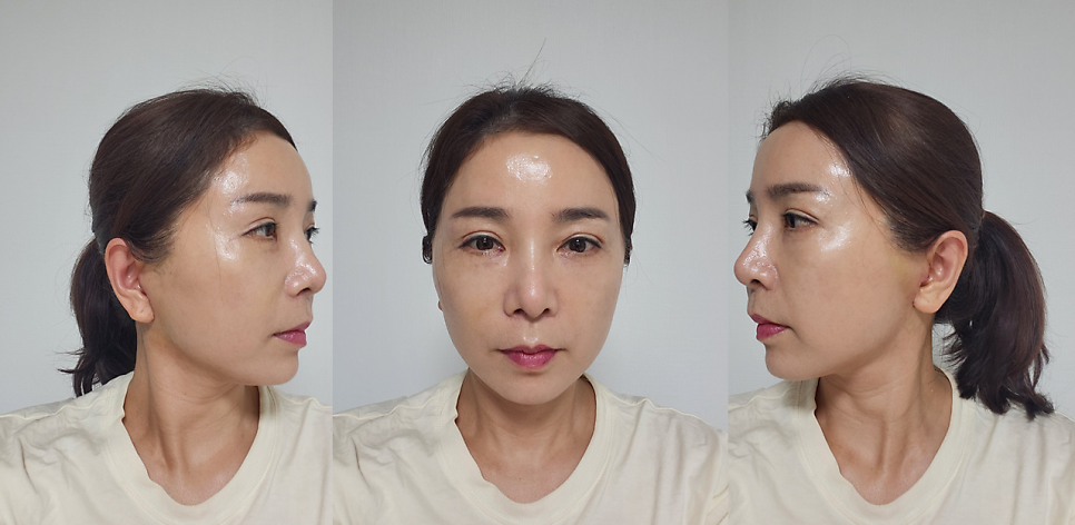 노화의 원인을 교정하는 중년성형 수술 관련 이미지 7