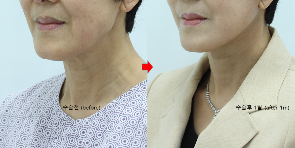 Deep Plane Facelift and Neck Lift image 6