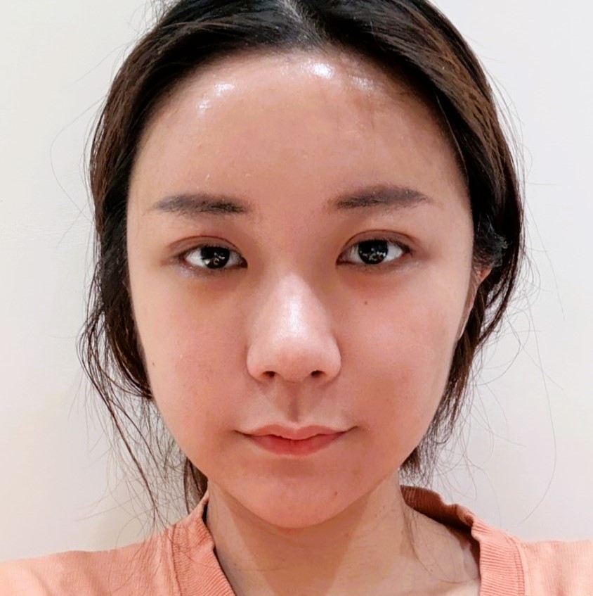 20~30대 종합성형 수술순서와 회복기간 관련 이미지 5