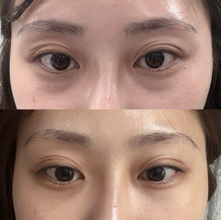 눈밑지방재배치, 복시&middot;사시는 걱정해야 할까요? (드문 부작용과 회복 과정) 관련 이미지 7