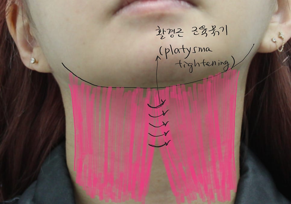 Submental Incision Neck Lift for a Deep Neck Line image 5