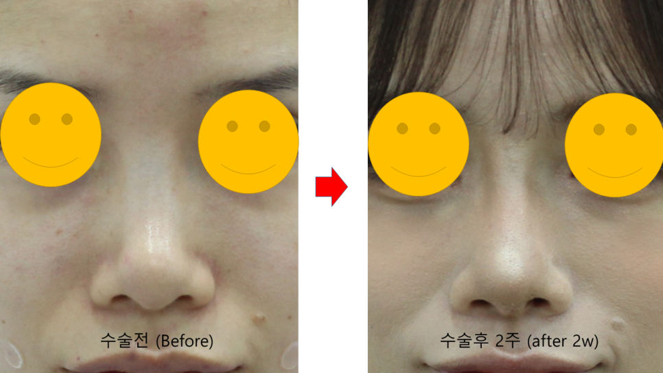 코필러 퍼짐과 필러비침현상(틴들현상) 관련 이미지 9