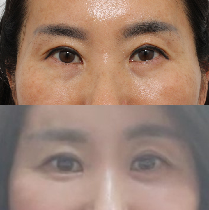 하안검 vs 눈밑지방재배치, 40~50대에서 선택하기 관련 이미지 5