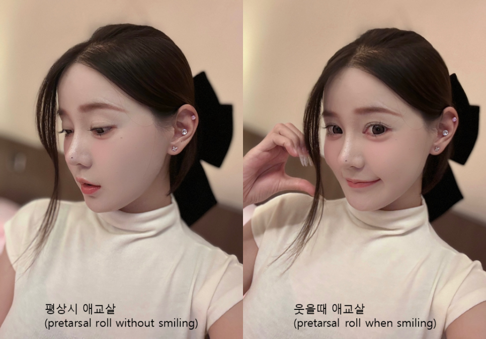 Molding in Micro-Fat Grafting for Aegyo Sal image 4