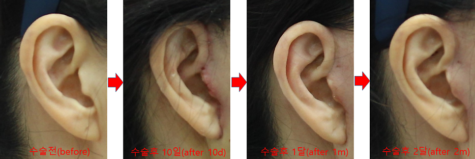 Changes in Incisions and Scars in Deep Mini Facelift image 5
