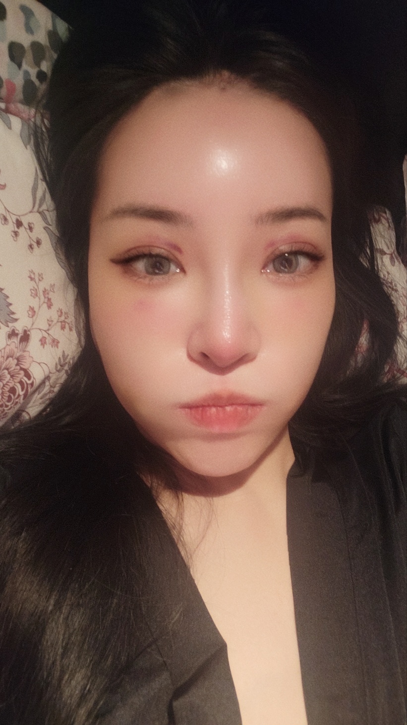 상안검 성형과 이마거상을 함께 했을 때 장점 관련 이미지 11