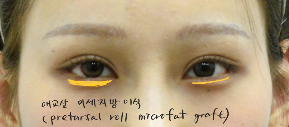 애교살 비대칭의 교정 방법 관련 이미지 5