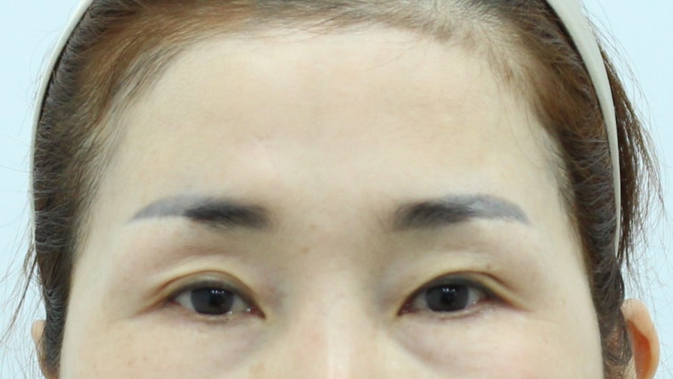 The Effect of Forehead Lift Surgery on the Eyes image 2