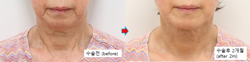 심한 목처짐 개선, 목거상의 핵심은 심부 볼륨과 피부 재배치입니다 관련 이미지 7