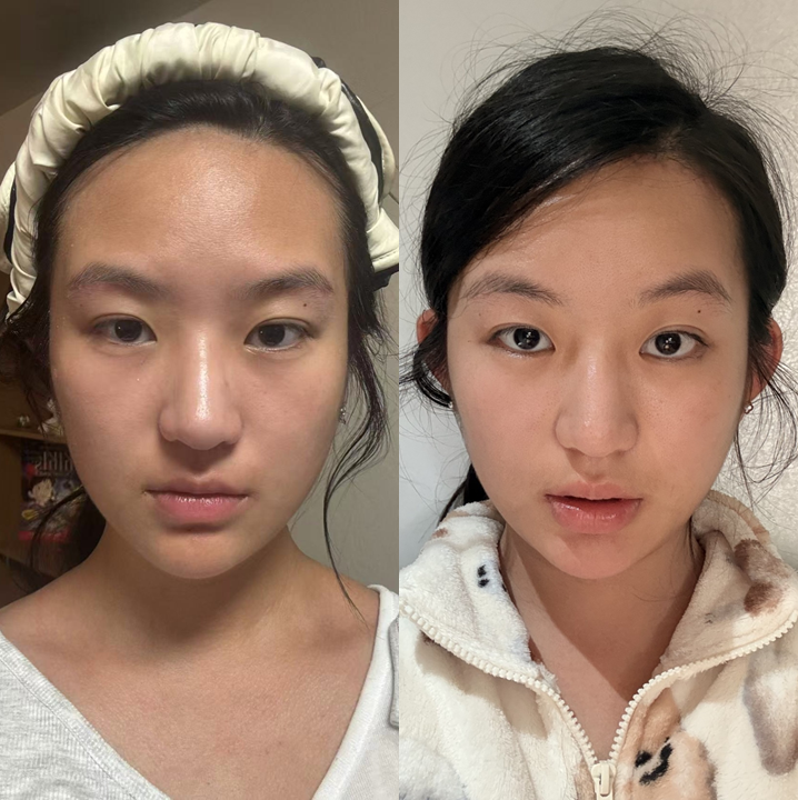 얼굴의 황금비율을 완성하는 이마축소술 관련 이미지 6