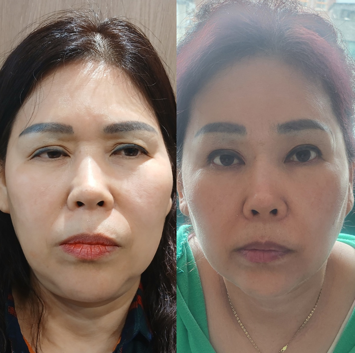 복합적인 눈 문제, 하나의 수술보다 원인별 교정이 중요한 이유 관련 이미지 7