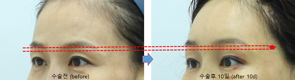 Forehead Lift to Correct Eyebrow Asymmetry image 7