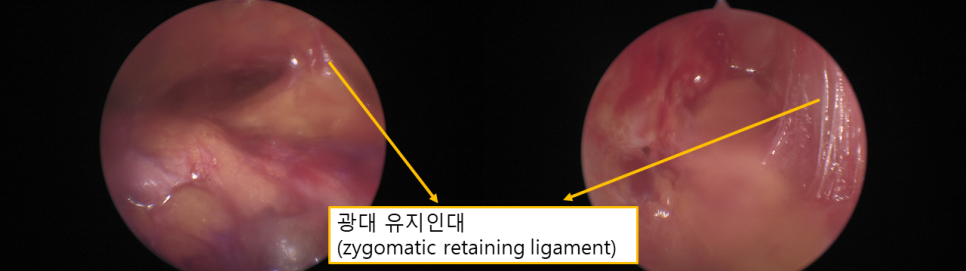 광대축소술 후 볼처짐과 미니거상, 흉터 부담은 줄이고 자연스럽게 관련 이미지 2