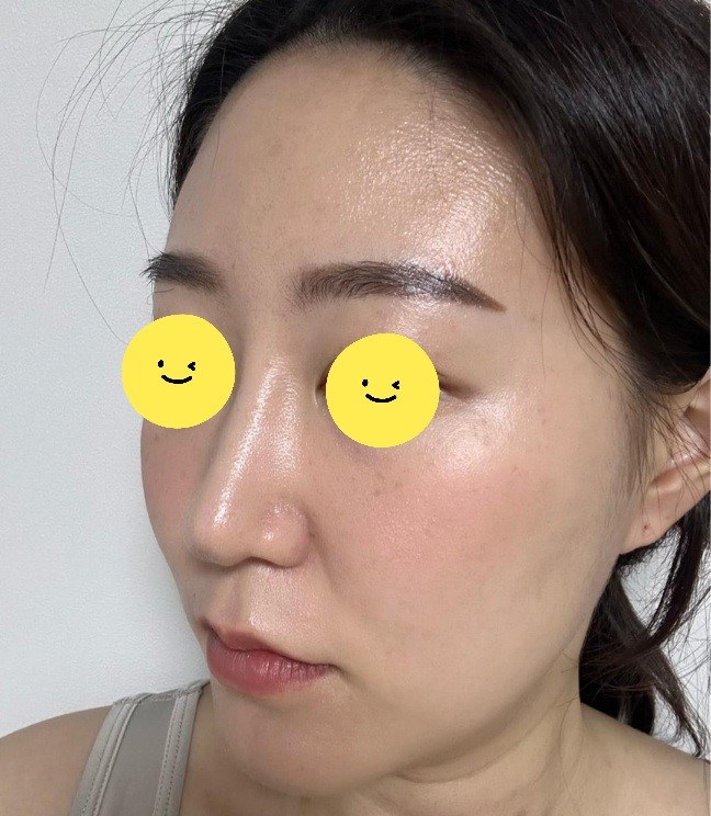긴코 교정과 비순각 조절을 위한 코끝 리모델링 관련 이미지 1