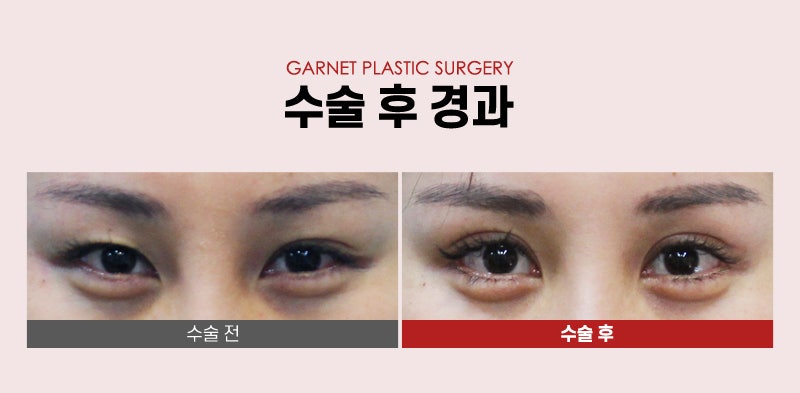 【Garnet Plastic Surgery Director Baek In-soo’s Plastic Surgery Column】 Eye Correction for a Rounder, Kinder Eye Shape image 7