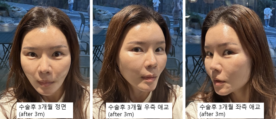 40대 후반 눈밑성형, 꼭 하안검일까? 눈밑지방재배치로 해결한 이유 관련 이미지 4