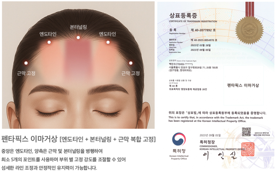 이마거상술 고정법, 엔도타인과 실고정 중 무엇이 더 좋을까요? 관련 이미지 3