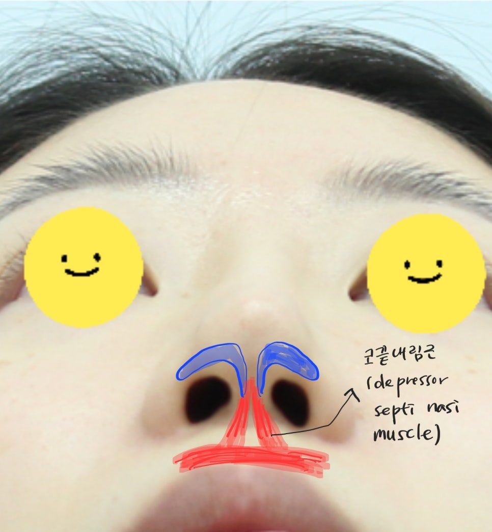 긴코 교정과 비순각 조절을 위한 코끝 리모델링 관련 이미지 4