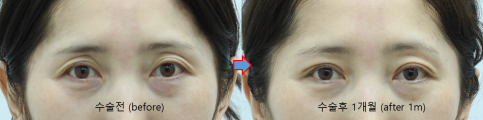 How to Address Double Eyelids and Hollow Eyes by Improving Both the Line and Volume image 4